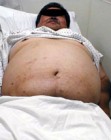 A kövérség egy veszélyes testi-lelki betegség!